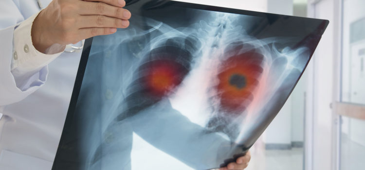 10 Myths About Lung Cancer Debunked by a Thoracic Surgeon